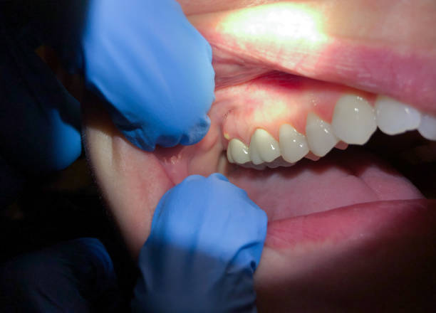 Best Emergency Tooth Extraction in Millwood, WA